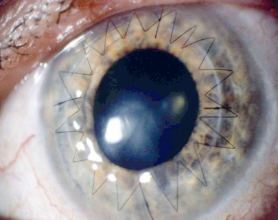 研究揭示了增加视力恢复手术所需眼捐献的尚未开发的潜力